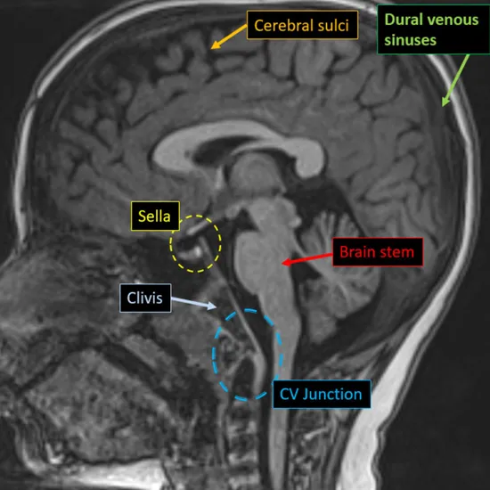 MRI Brain With CV Junction